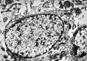 F,12y. | oligodendroglioma F,12y. | oligodendroglioma